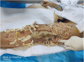 网红小冉坏死性筋膜炎的简单介绍